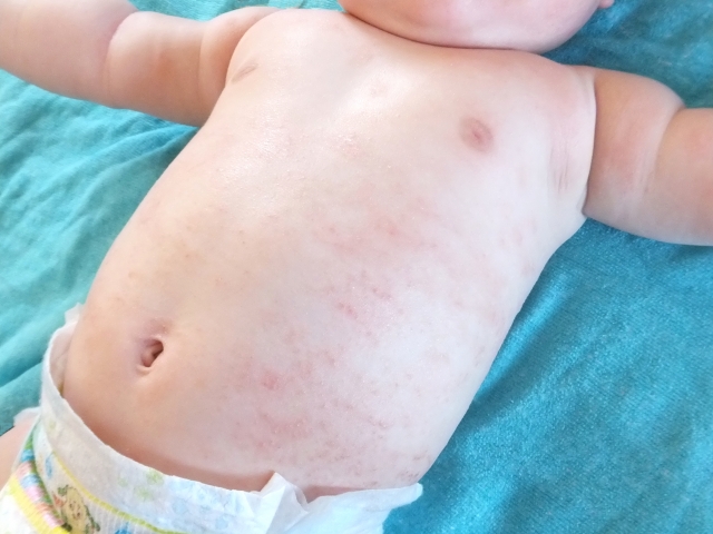 1歳までの子供がかかる 突発性発疹 とは 1歳までの子供がかかる 突発性発疹 とは